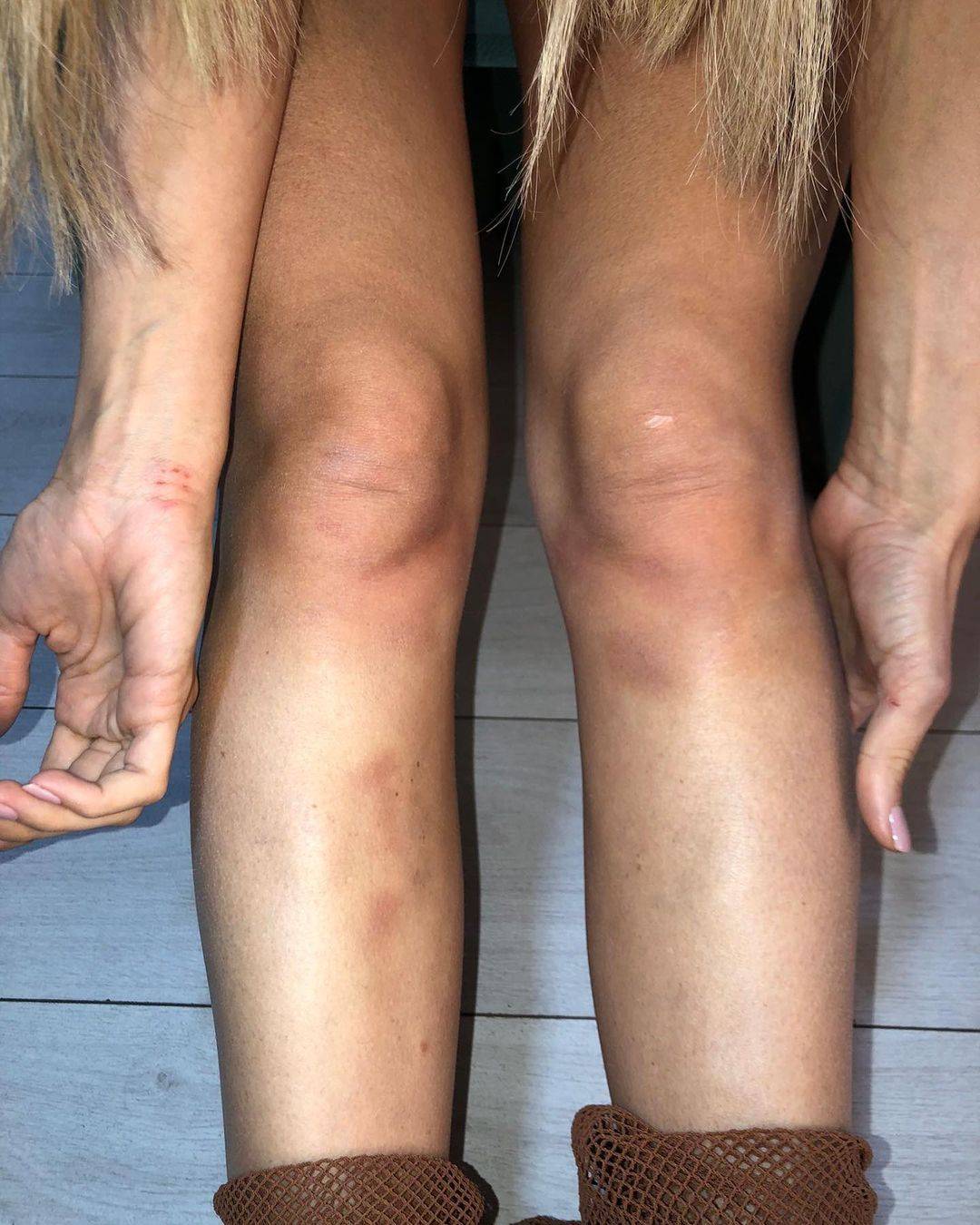 Milica u MODRICAMA, PODLIVIMA I BOLOVIMA! Pevačica okačila fotku, fanovi ŠOKIRANI 3 4832ac78bfe3476433e8fdb783ee1b9251766b99