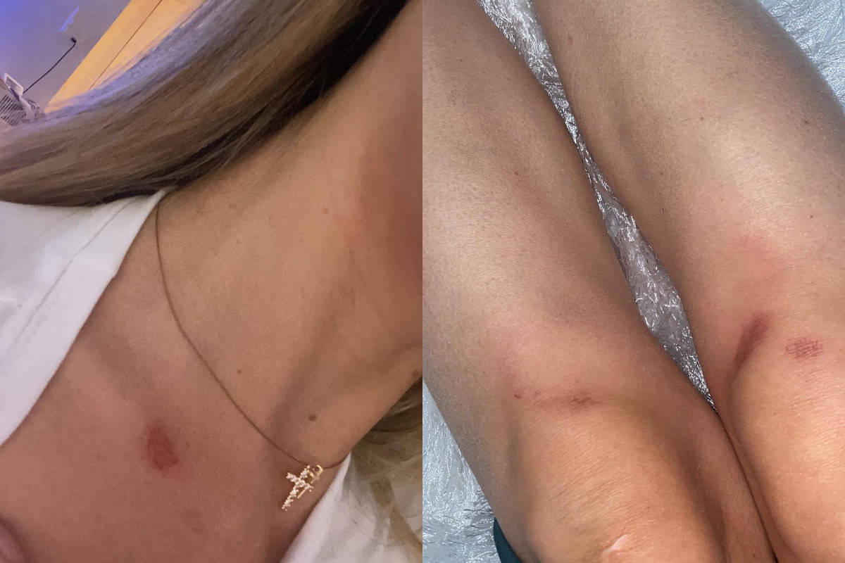 Milica u MODRICAMA, PODLIVIMA I BOLOVIMA! Pevačica okačila fotku, fanovi ŠOKIRANI 4 5022a635175edb440691987a9ad9c5e1c0f264ce