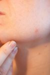 Prirodni losion za negu lica: Sve sastojke sigurno imate kod kuće 2 acne ga797737a0 1920