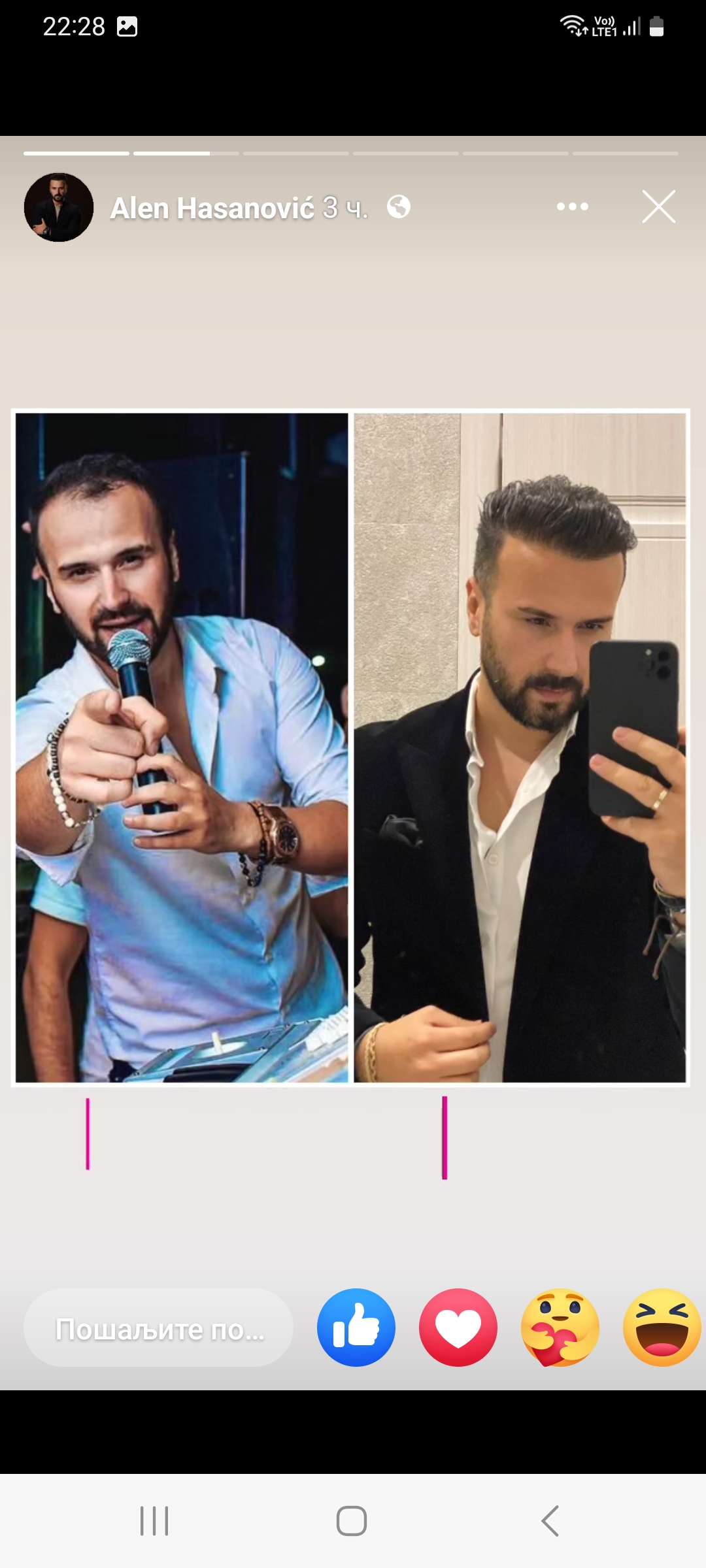 Alen Hasanovic transplantacija kose 2
