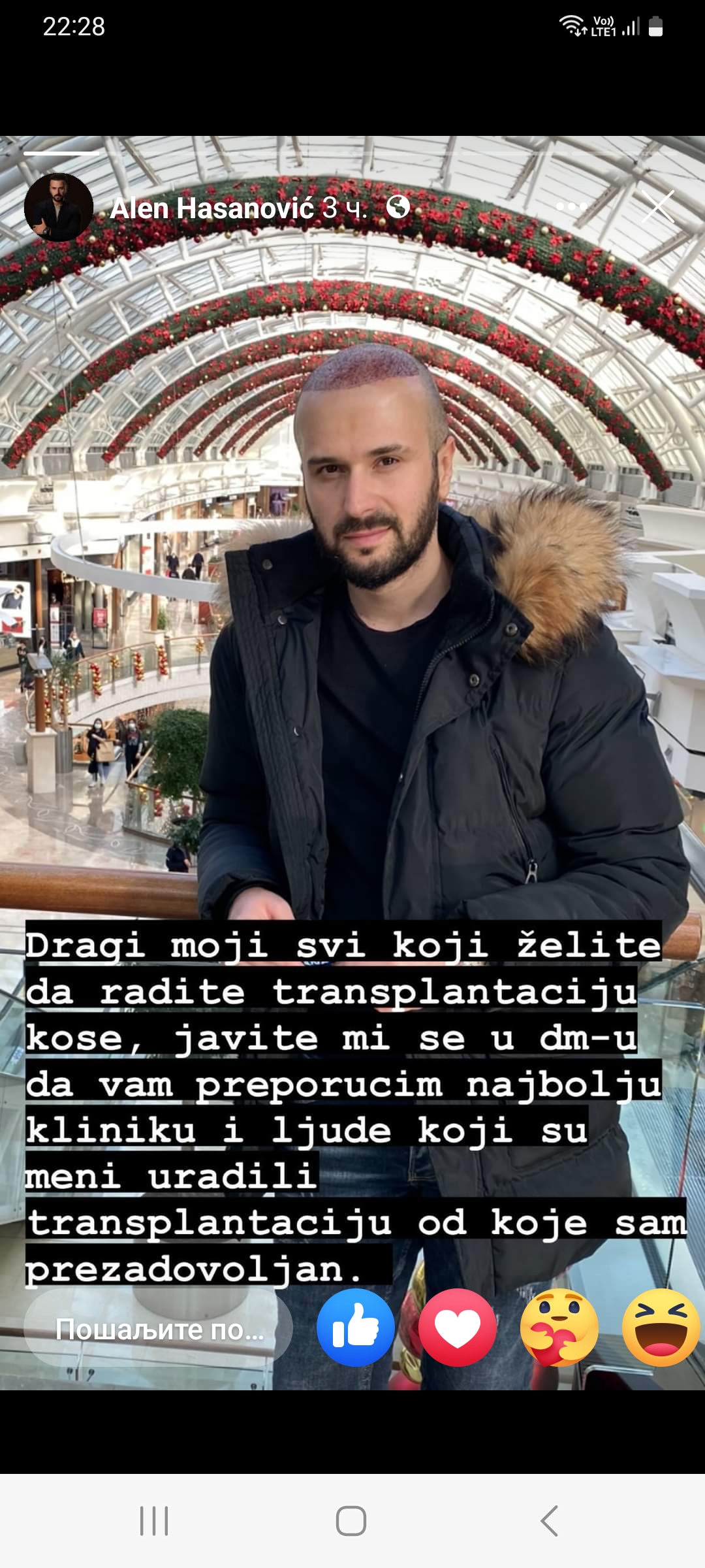 Alen Hasanovic transplantacija kose